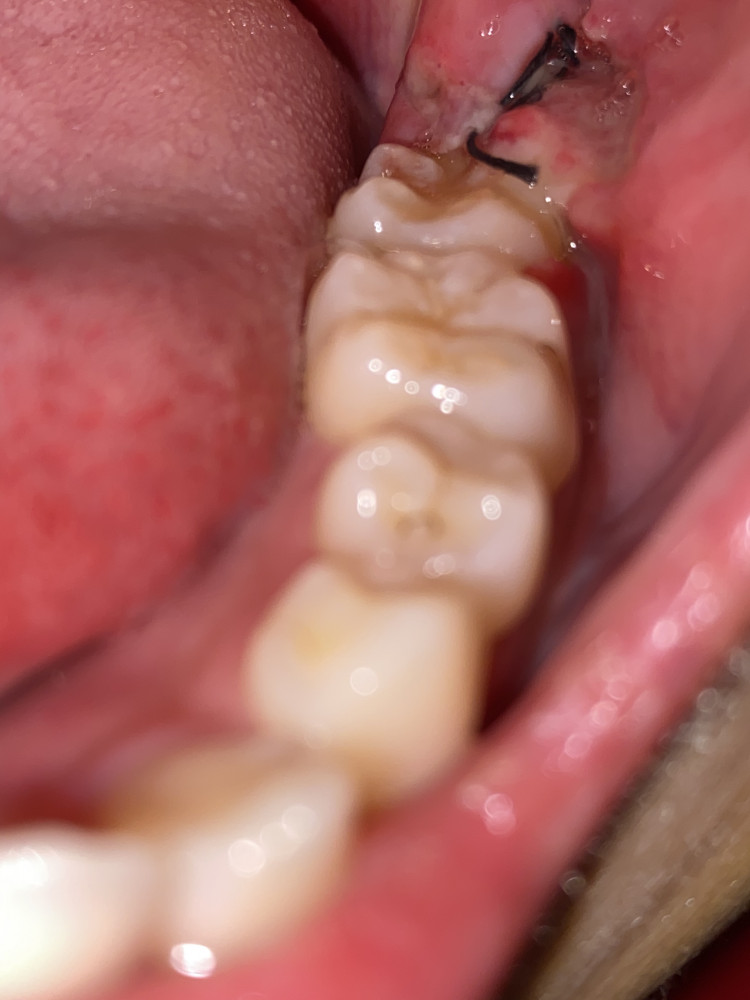 歯茎 奥歯 腫れ の